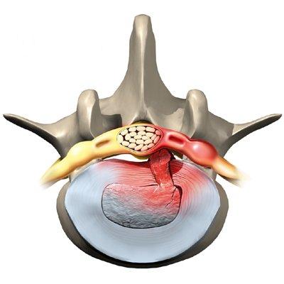 herniated disc in back